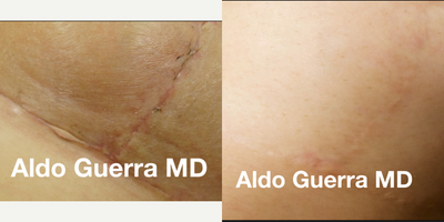 25-34 year old woman treated with Embrace Scar Therapy - Before and after embrace Active Scar treatments for vertical breast lift incision.