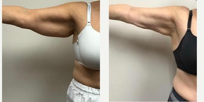 55-64 year old woman treated with Arm Lift - 56 year old female shown before and one year after a bilateral brachioplasty (arm lift). She is 50 tall and weighs 135 pounds. The incision was placed on the inner arm from the axilla to the elbow. All procedures done by Dr. Frank J. Ferraro, MD.