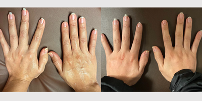 45-54 year old woman treated with Radiesse - The patient pictured was injected with Radiesse filler to treat wrinkled skin on hands.