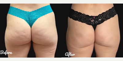 Woman treated with Qwo - Woman treated with Qwo
