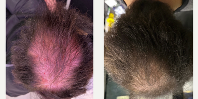 Man treated with PRP Injections, PRP for Hair Loss - Man treated with PRP Injections, PRP for Hair Loss