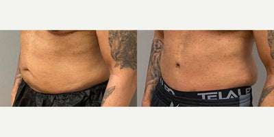 55-64 year old man treated with Male Tummy Tuck - 59 yo male s/p abdominoplasty performed under general anesthesia in our on site AAAA certified operating room suite.