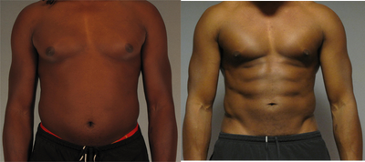 40-year-old Male Abdominal Etching  - This 40-year-old male patient was unhappy with the extra fat on his stomach. He heard about Dr. Mentz's abdominal etching technique and paid him a visit for consultation. Dr. Mentz performed a full abdominal etching procedure on this patient.&nbsp;