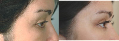 Latisse for eyelashes - 
	Latisse before and after pictures for mid 40&#39;s female patient with short, sparse eyebrows. Long Beach, CA Latisse doctor.
