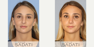 Septo-Rhinoplasty Procedure on Orange County Female - Septo-Rhinoplasty Procedure on Orange County Female