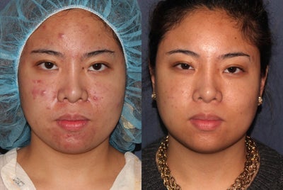 Photodynamic therapy (PDT) for severe acne - I treated this 25 year old female treated with PDT for acne.  I used a combination of Vbeam Perfecta, red and blue light, and Levulan. PDT is excellent for acne that is not responding to other treatments or for patients that don't want to take pills or use lots of different products.