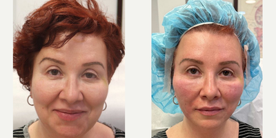 45-54 year old woman treated with Nonsurgical Facelift, Thread Lift - Witness the magic of Dr. GolBerg's non-surgical facelift, which combines PDO threads, PRF, and other bio-stimulating materials to contour the face with minima downtime and long lasting results.