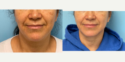 45-54 year old woman treated with ThermiTight - 50 year old female treated with Thermitight Laser and Neck Liposuction