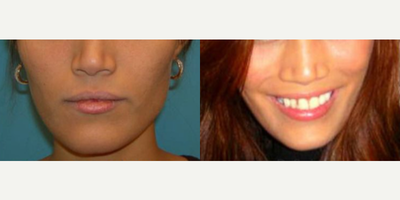 25-34 year old woman treated with Jaw Reduction - 25-34 year old woman treated with Jaw Reduction
