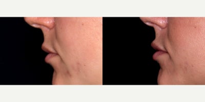 33 year old woman treated with Lip Fillers (Restylane Kysse) - 33 year old woman treated with Lip Fillers (Restylane Kysse) Photos depict before and 1 month after 1 syringe to lips.