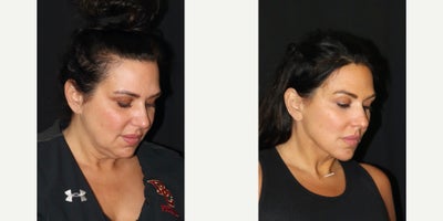45-54 year old woman treated with Facelift, Deep Plane Facelift, Neck Lift - I love the natural look that I was able to achieve for this beautiful 46 y/o!!! Using a deep plane facelift , platysmaplasty , and deep neck fat removal (under the muscles), I was able to reposition the cheeks slightly higher and create an iconic jawline and neck that highlights her gorgeous eyes and lips!!! Her face now has a more youthful diamond shape.
