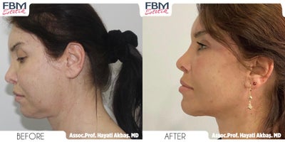 35-44 year old woman treated with Facelift, Mini Neck Lift - 35-44 year old woman treated with Facelift, Mini Neck Lift