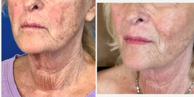 75 and up year old woman treated with Cheek Fillers, Laser Liposuction, Nonsurgical Facelift, Miracu, Nonsurgical Neck Lift, Rad - Facial Rejuvenation in the hands of Dr. Jeffrey Rosenthal, requires a combination of procedures to stimulate collagen with the Endolift Laser, Lift and support sagging face, jaw and neck skin with PDO Threads (Miracu and Mint) and replace lost volume with Radiesse and RHA fillers. Harmony and Balance of the face and neck is the ideal rejuvenation.