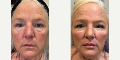 55-64 year old woman treated with Xeomin, Dermal Fillers, Cheek Fillers, Lip Fillers, Juvederm, Revanesse, Radiesse, Belotero - 1 syringe of versa to each check (2mL total)1 syringe of Radiesse split between cheeks (1.5mL total)1mL of belotero to tear troughs1mL of Vollure to lips1.5mL of Belotero to peri-oral lines and oral commissures62 units of Xeomin - 16 units to jawline, 20 units to frown lines, 14 units to forehead, 12 units to crows feet