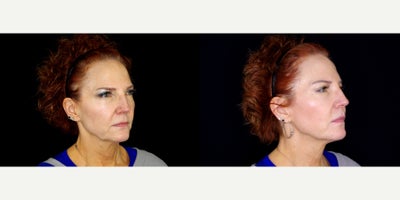 60 year old woman treated with Thread Lift - 60 year old woman treated with Thread Lift. Photos depict before and 3 months after 18 Novathreads