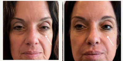 45-54 year old woman treated with Belotero - Filler treatment for tear-through area