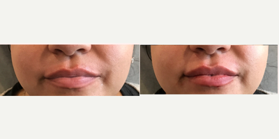 35-44 year old woman treated with Lip Fillers - Juvederm ultra for lips