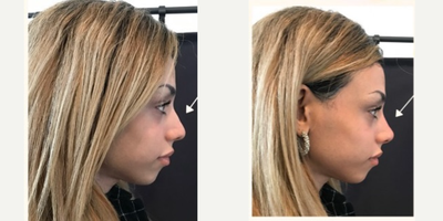 25-34 year old man treated with Nonsurgical Nose Job - non surgical nose job using fillers only.