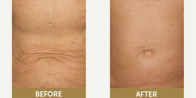 Woman treated with Thermage - Woman treated with Thermage