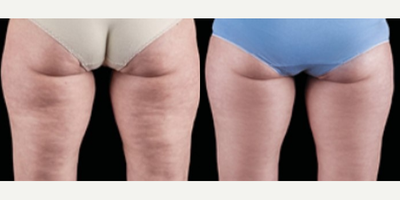 Woman treated with Emtone - Woman treated with Emtone