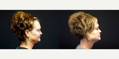 45-54 year old woman treated with Infini RF - 54 year old female received three Infini treatments to her lower face and neck; photos depict the patient's results 3 months post-treatment.