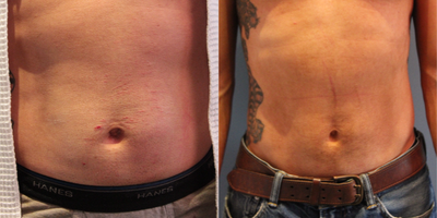 45 year old man treated with VelaShape - This 45 year old patient was treated with VelaShape and UltraShape, both non-invasive body contouring treatments, to improve the appearance of his abdomen.