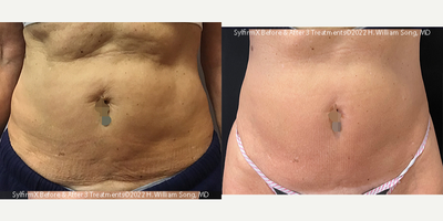 55-64 year old woman treated with Microneedling RF - Before and after 3 treatments with SylfirmX radiofrequency micro needling treatments to tighten skin laxity