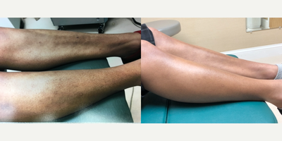 18-24 year old woman treated with Pico Genesis - After one treatment to treat hyperpigmentation.