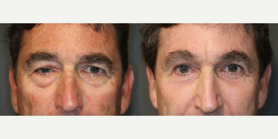 Complicated Upper and Lower Lid Rejuvenation - Significant eyelid issues after repeated retinal surgeries. Corrected with brow lift, upper and lower eyelid surgery with CO2 laser.