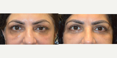 customized eyelid surgery - 50+ year old woman underwent left droopy upper eyelid ptosis surgery, bilateral upper blepharoplasty and bilateral lower blepharoplasty. Note more refreshed results and improvement in the eye asymmetry.