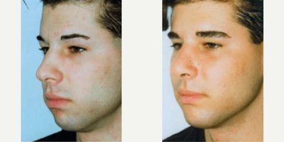 Man treated with Chin Implant - Man treated with Chin Implant