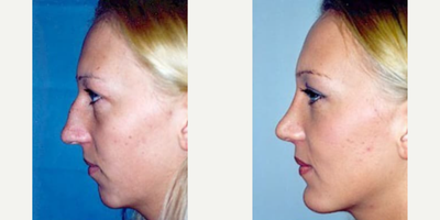 Woman treated with Chin Implant - Woman treated with Chin Implant and Rhinoplasty