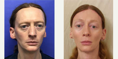 Patient treated with Cheek Augmentation - Cheek Implants (small) - 35 to 44 year-old female patient is 1 year post-op from Facial Feminization surgery. Her procedures included: Forehead Lift, Hairline Lowering, Orbital Bony Contouring, Septorhinoplasty (open) with Cartilage Grafts and Weirs, Thyroid Cartilage Shave Revision, Chin Reduction and Contour, Cheek Implants (small), Intranasal Lip Lift, and Soft Tissue to Lips.