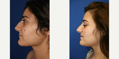 Rhinoplasty (side view L) - Rhinoplasty