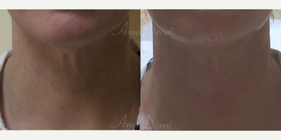 55-64 year old woman treated with Non-Surgical Neck Lift - Nonsurgical neck lift and rejuvenation with PDO Thread Lift procedure