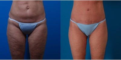 55-64 year old woman treated with Thigh Lift - Procedure: Lower body lift, liposuction of abdomen and flanks, and secondary medial thigh lifts.