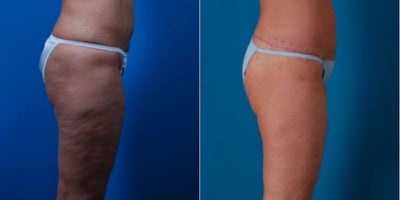 55-64 year old woman treated with Thigh Lift - Procedure: Lower body lift, liposuction of abdomen and flanks, and secondary medial thigh lifts.