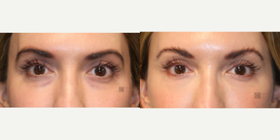 Woman treated with PRP Vampire Facelift - Filler to temples, eyes and microneedling with PRP.