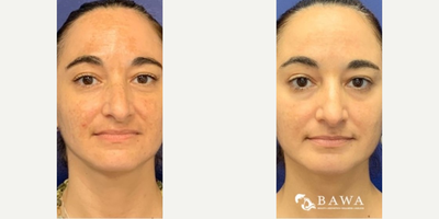 Woman treated with Silhouette Soft - Woman treated with Silhouette Soft