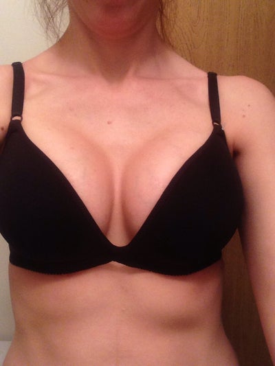 👉 350cc Breast Implants - 350cc Breast Augmentation NYC