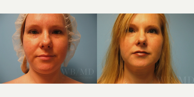 34 year old woman treated with Chin Surgery - 34 year old woman treated with Chin Surgery through liposuction of chin as well as neck area.