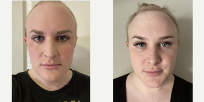 25-34 year old woman treated with MTF Facial Feminization Surgery - A 32 year old transgender woman underwent a Foreheadplasty (forehead lift) with reduction of Frontal Bossing and Orbital Shaping, Hairline advancement, Septorhinoplasty, Cheek Augmentation with Fat Transfer, Chin Contouring, and Submental (neck) Liposuction.