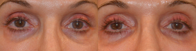 45-54 year old woman treated with Venus Viva - Venus Viva fractional radiofrequency/RF treatment is fantastic for facial resurfacing (wrinkles, sun spots, crepe skin, fine lines, pore reduction, and texture improvements), scars, and melasma.  Since it is not a laser it can be used on all skin types (including darker skin and sensitive skin like those with eczema and/or rosacea).  It is also fantastic for acne, as it helps the topical medications used to treat acne to penetrate the skin more readily.  Long term tightening and lifting is improved with Venus Viva in combination with other skin tightening procedures such as radiofrequency/RF like Venus Legacy or ultrasound like Ultherapy.