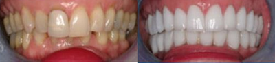 55-64 year old woman treated with Lumineers - Before and after Lumineers