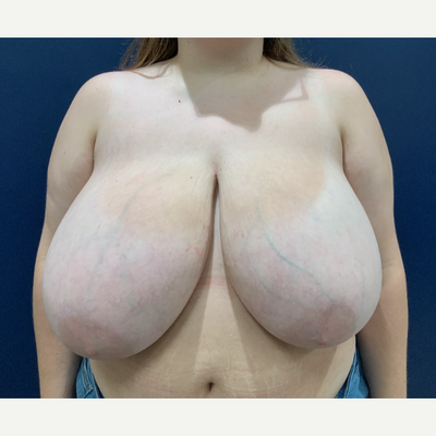 18-24 year old woman treated with Breast Reduction - This patient underwent a bilateral breast reduction with Dr. Jocelyn Leveque. In total 1880 grams were removed from the breasts. She is very happy with her result. Individual results may vary. Age: between 18 and 24 years oldPrevious bra size: 38HPost Op Timeline: 3months