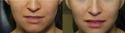 25-34 year old woman treated with Juvederm - Upper lift filler