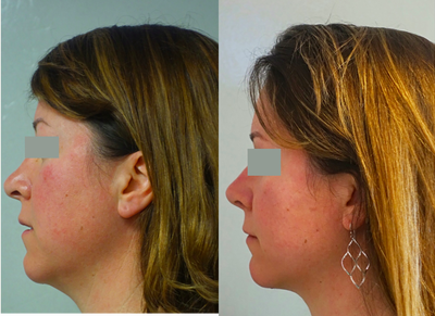 Chin Liposuction - Chin Liposuction
