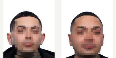 33 year old man treated with Ear Surgery - This 33-year-old male was concerned about the appearance of his ears. He underwent otoplasty, resulting in a more harmonious and naturally positioned ear appearance.