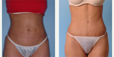 24 year old woman treated with Tummy Tuck - 24 year old woman treated with Tummy Tuck and Liposuction to abdomen, waist, mons area, and lumbar roll. Post-op, patient was happy to return to her pre-pregnancy body. She is 5'1 tall and weighed 119 lbs.