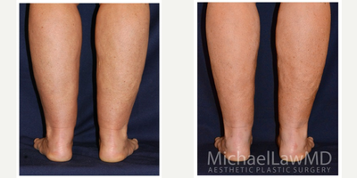 45-54 year old woman treated with Calf Reduction - Lower leg liposcution